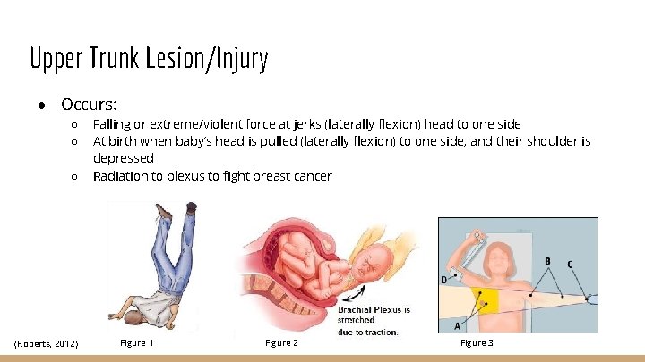 Upper Trunk Lesion/Injury ● Occurs: ○ ○ ○ (Roberts, 2012) Falling or extreme/violent force