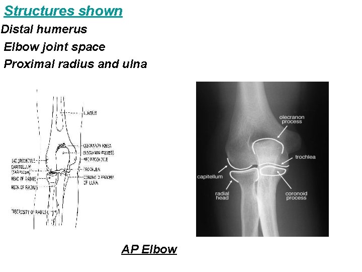Structures shown Distal humerus Elbow joint space Proximal radius and ulna AP Elbow 