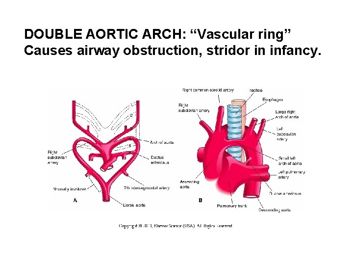 DOUBLE AORTIC ARCH: “Vascular ring” Causes airway obstruction, stridor in infancy. 