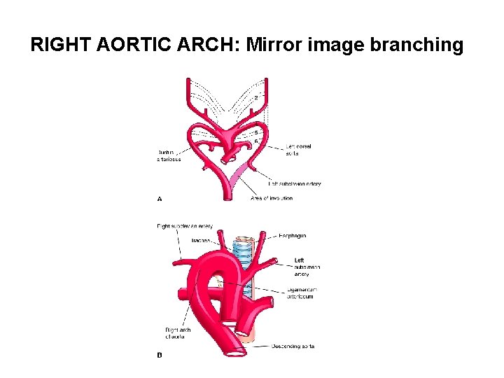 RIGHT AORTIC ARCH: Mirror image branching 