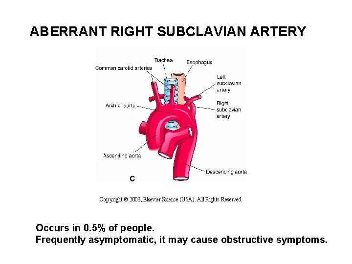 ABERRANT RIGHT SUBCLAVIAN ARTERY Occurs in 0. 5% of people. Frequently asymptomatic, it may