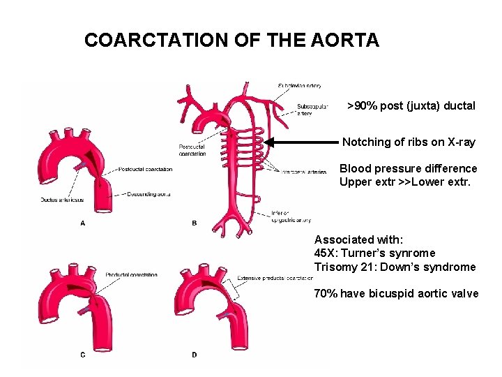 COARCTATION OF THE AORTA >90% post (juxta) ductal Notching of ribs on X-ray Blood