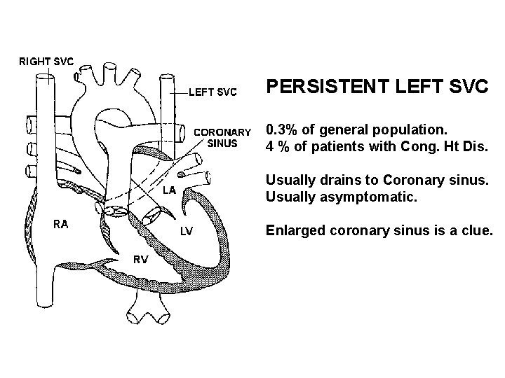 PERSISTENT LEFT SVC 0. 3% of general population. 4 % of patients with Cong.