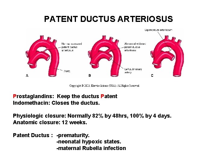 PATENT DUCTUS ARTERIOSUS Prostaglandins: Keep the ductus Patent Indomethacin: Closes the ductus. Physiologic closure: