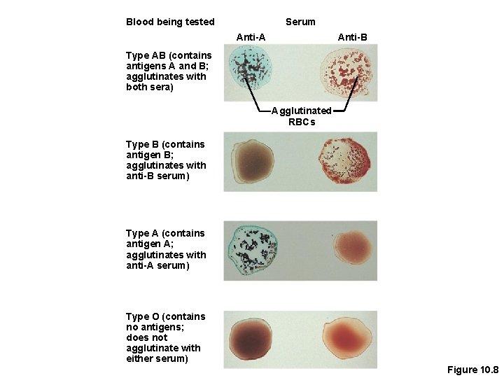 Blood being tested Serum Anti-B Anti-A Type AB (contains antigens A and B; agglutinates
