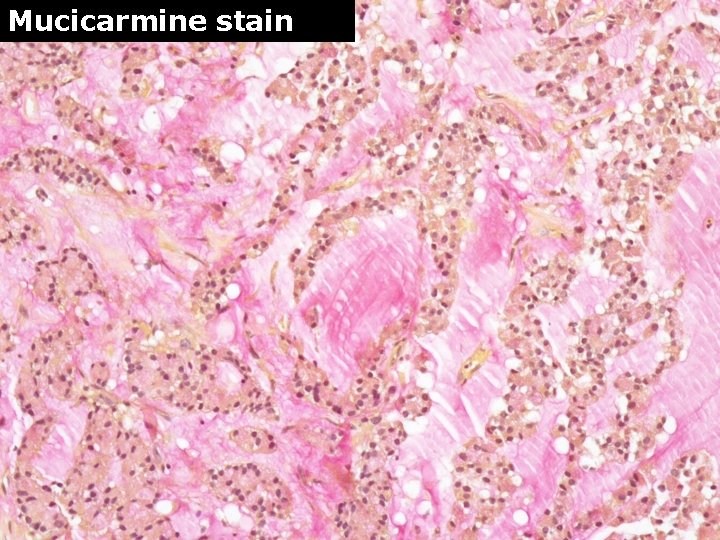 Mucicarmine stain 