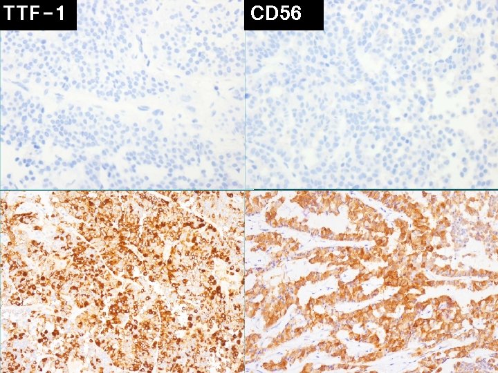 TTF-1 CD 56 