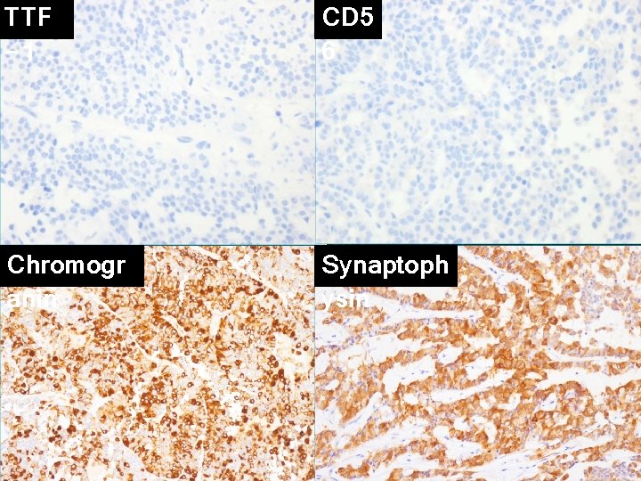 TTF -1 CD 5 6 Chromogr anin Synaptoph ysin 