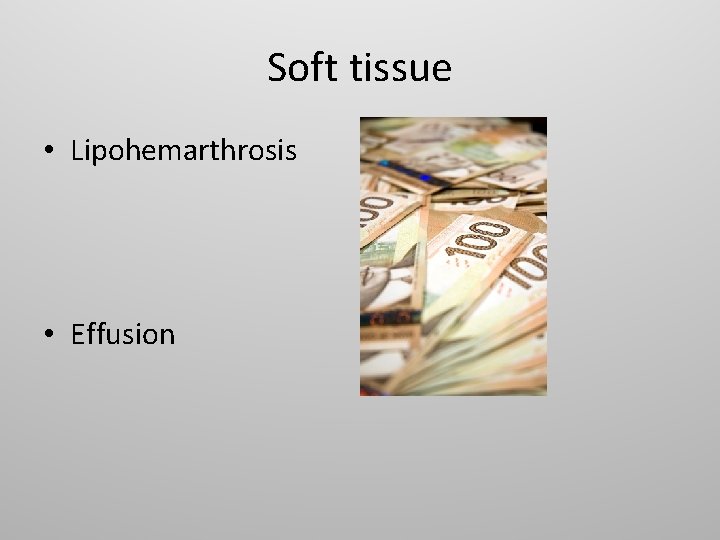 Soft tissue • Lipohemarthrosis • Effusion 