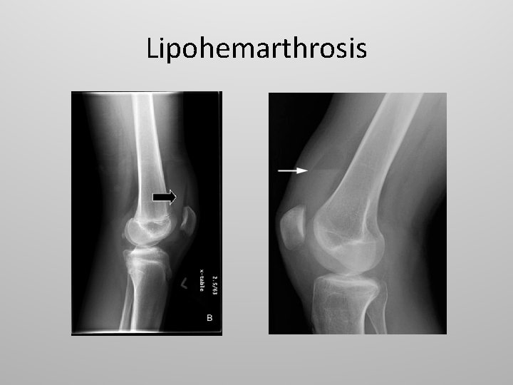 Lipohemarthrosis 