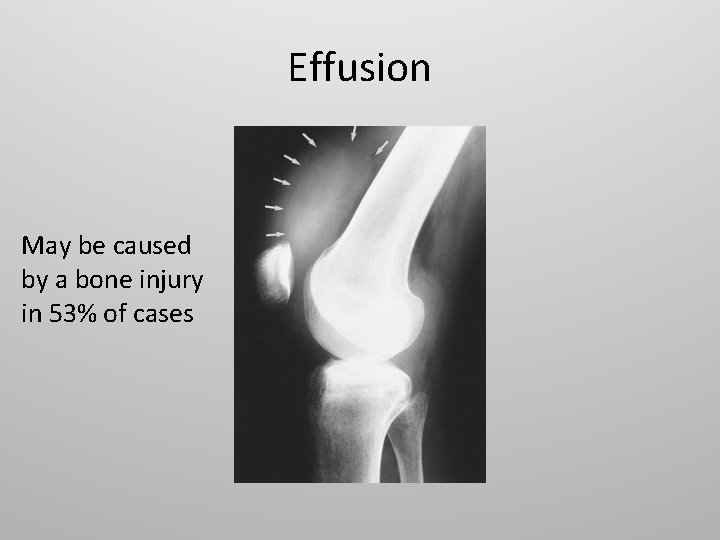 Effusion May be caused by a bone injury in 53% of cases 