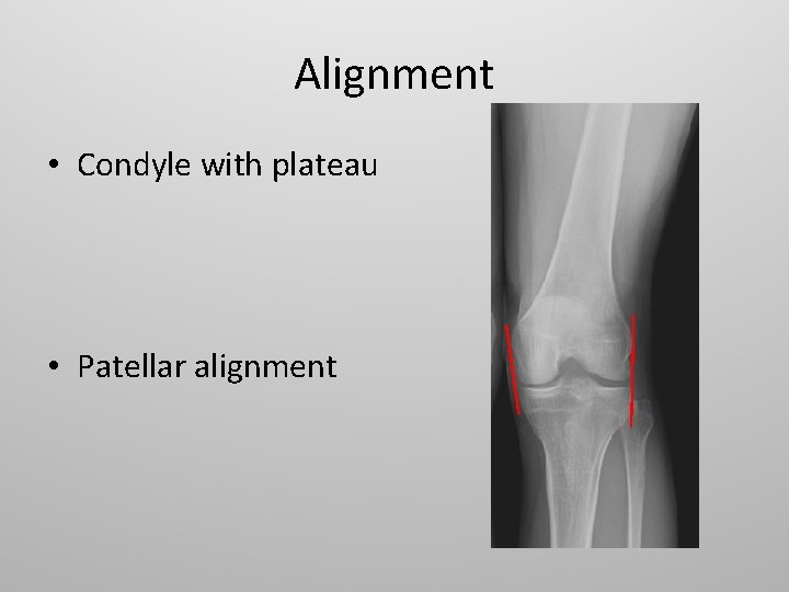 Alignment • Condyle with plateau • Patellar alignment 