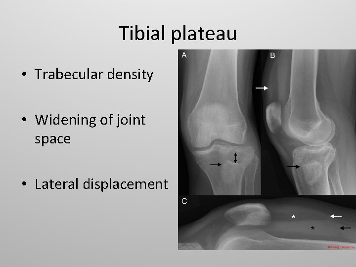 Tibial plateau • Trabecular density • Widening of joint space • Lateral displacement 