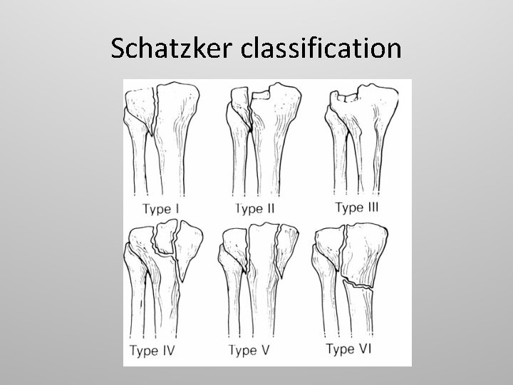 Schatzker classification 