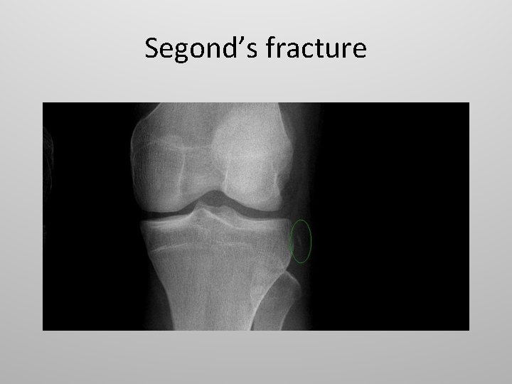 Segond’s fracture 