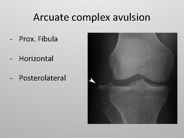 Arcuate complex avulsion - Prox. Fibula - Horizontal - Posterolateral 