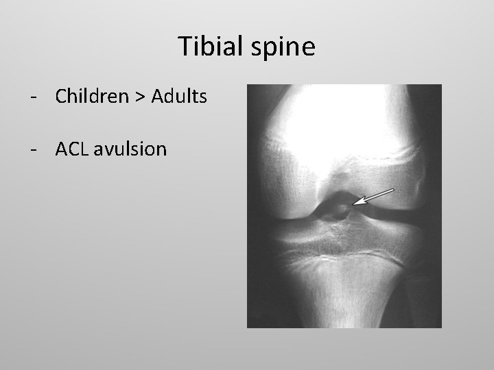 Tibial spine - Children > Adults - ACL avulsion 