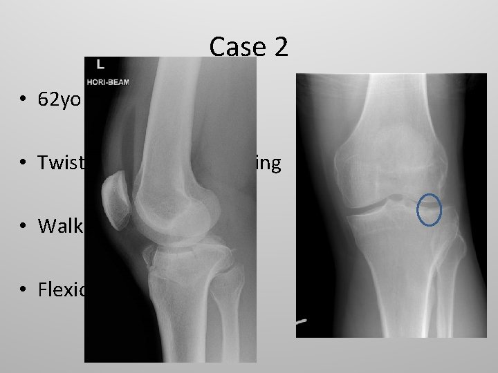 Case 2 • 62 yo F • Twisted knee while moving • Walking with