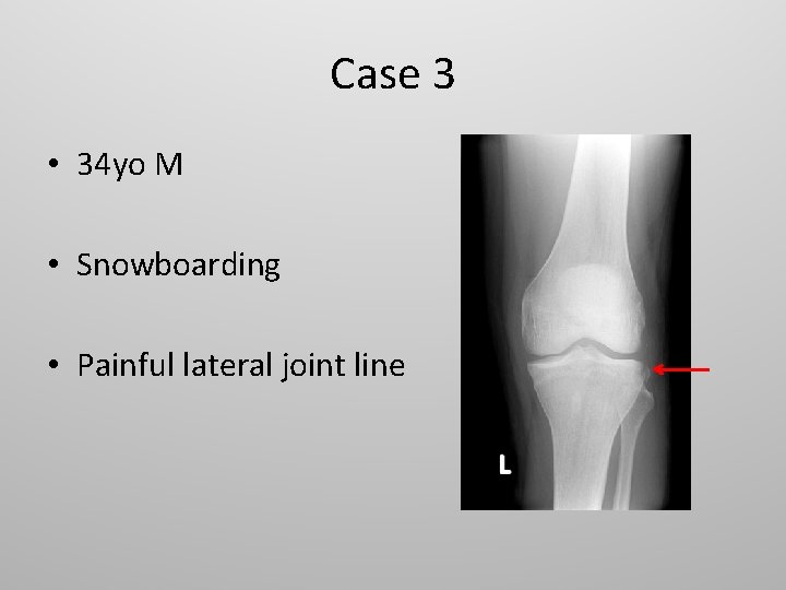 Case 3 • 34 yo M • Snowboarding • Painful lateral joint line 