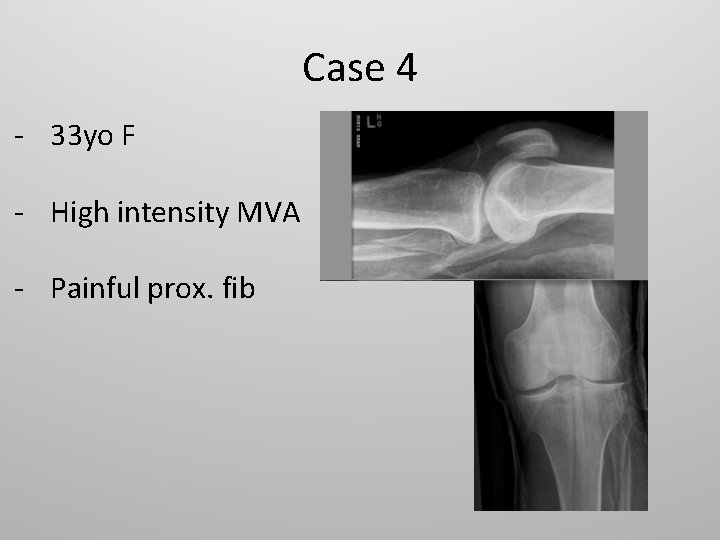 Case 4 - 33 yo F - High intensity MVA - Painful prox. fib