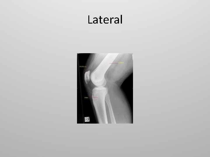 Lateral 