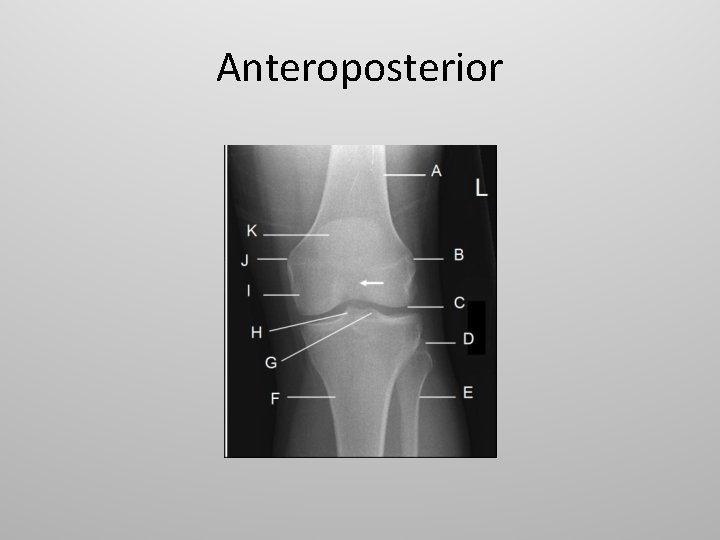 Anteroposterior 