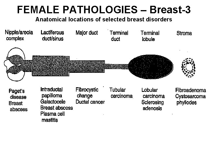 FEMALE PATHOLOGIES – Breast-3 Anatomical locations of selected breast disorders 