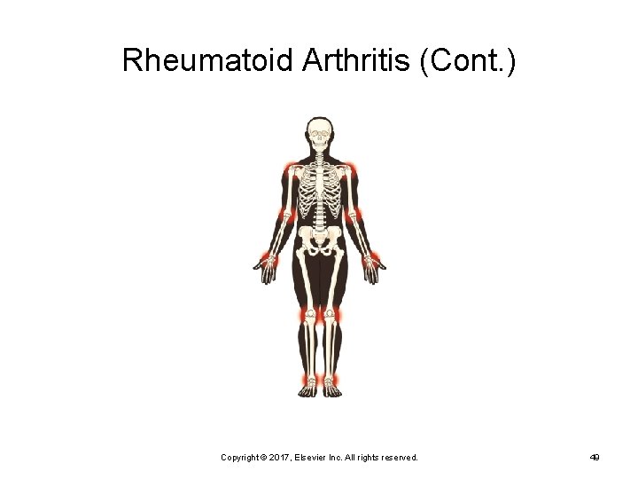 Rheumatoid Arthritis (Cont. ) Copyright © 2017, Elsevier Inc. All rights reserved. 49 