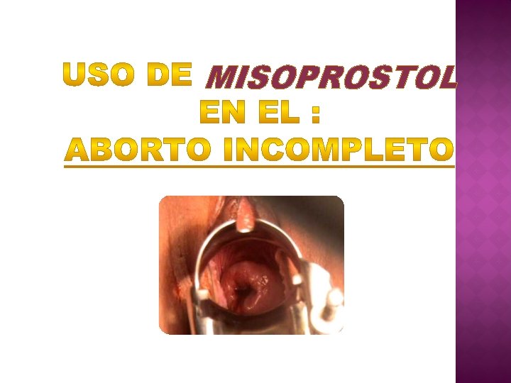 MISOPROSTOL 