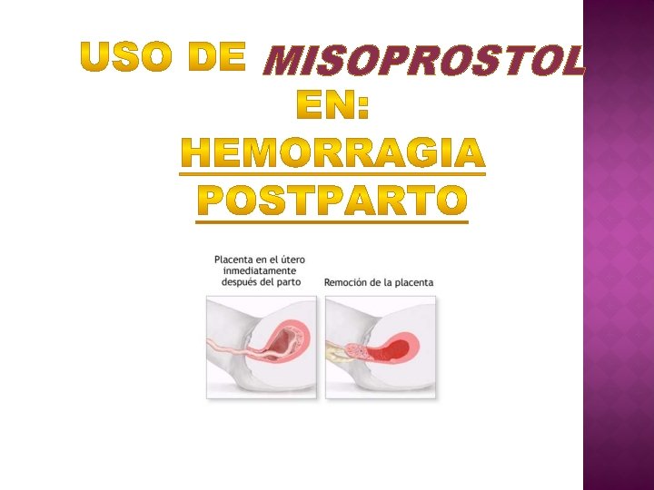 MISOPROSTOL 