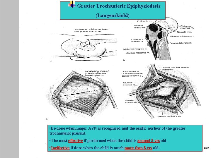 Greater Trochanteric Epiphysiodesis (Langenskiold) • Be done when major AVN is recognized and the