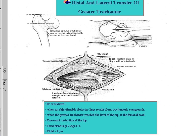 Distal And Lateral Transfer Of Greater Trochanter • Be considered : • when an