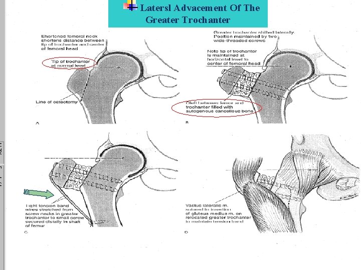 Latersl Advacement Of The Greater Trochanter 