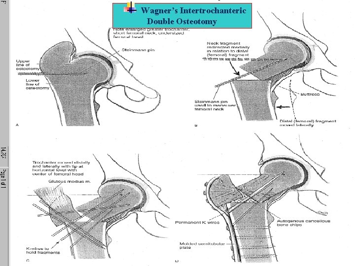 Wagner’s Intertrochanteric Double Osteotomy 