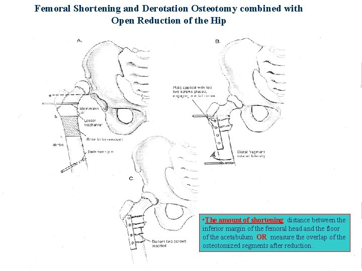 Femoral Shortening and Derotation Osteotomy combined with Open Reduction of the Hip • The