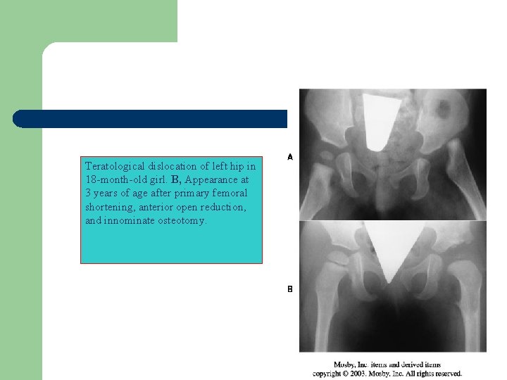 Teratological dislocation of left hip in 18 -month-old girl. B, Appearance at 3 years