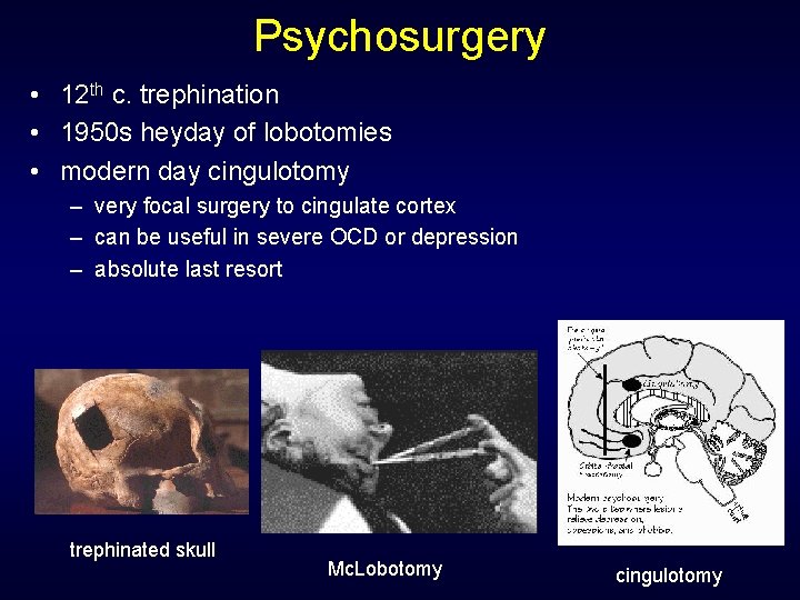 Psychosurgery • 12 th c. trephination • 1950 s heyday of lobotomies • modern
