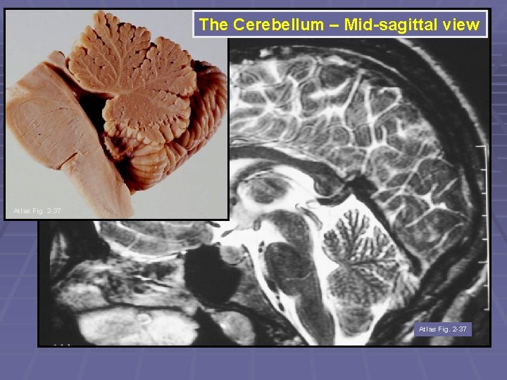 The Cerebellum – Mid-sagittal view Atlas Fig. 2 -37 