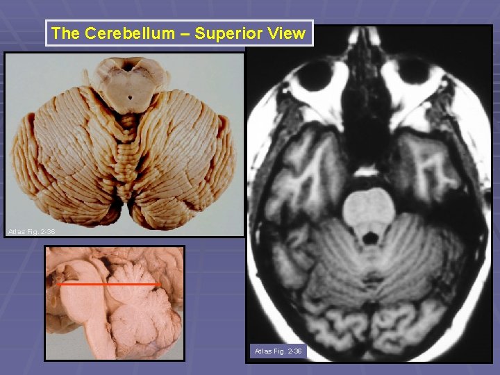 The Cerebellum – Superior View Atlas Fig. 2 -36 