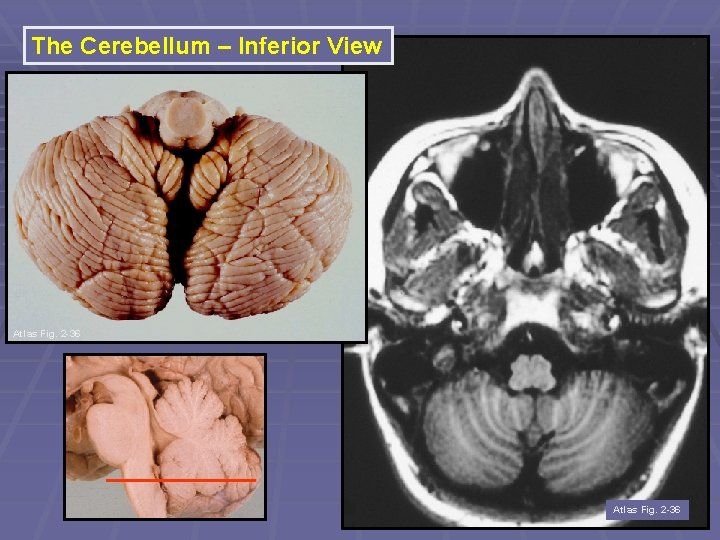 The Cerebellum – Inferior View Atlas Fig. 2 -36 