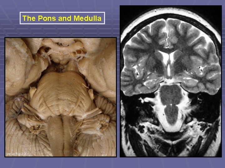 The Pons and Medulla Atlas Fig. 2 -20 