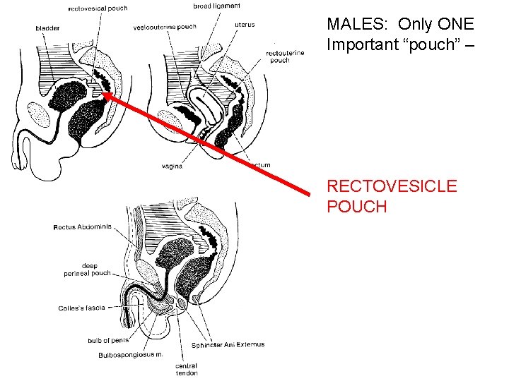 MALES: Only ONE Important “pouch” – RECTOVESICLE POUCH 