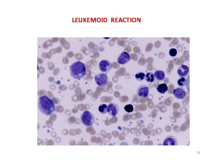 LEUKEMOID REACTION 19 