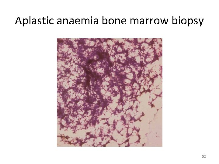 Aplastic anaemia bone marrow biopsy 52 