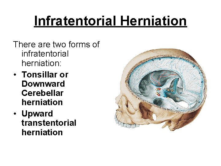 Infratentorial Herniation There are two forms of infratentorial herniation: • Tonsillar or Downward Cerebellar