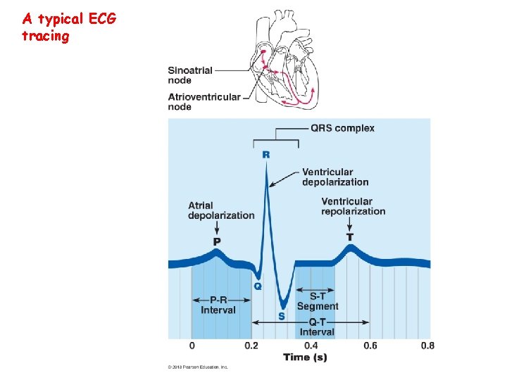 A typical ECG tracing 