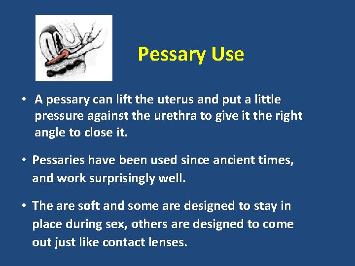 Pessary Use • A pessary can lift the uterus and put a little pressure