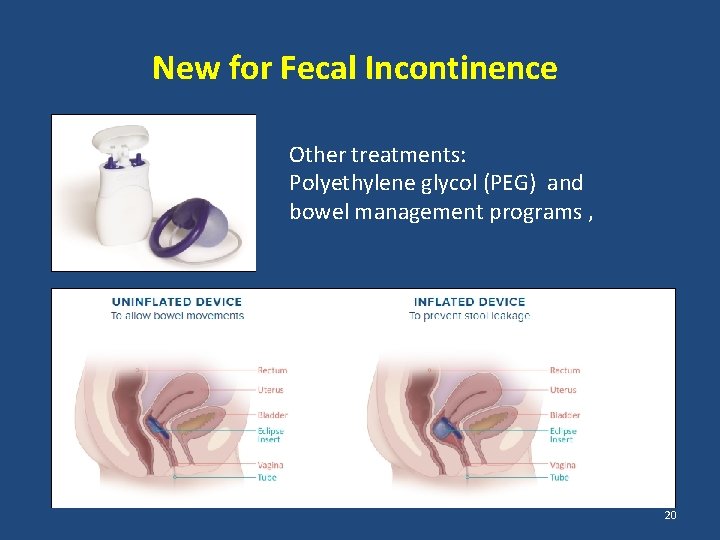 New for Fecal Incontinence Other treatments: Polyethylene glycol (PEG) and bowel management programs ,