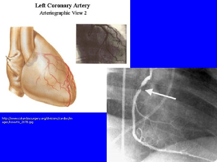 http: //www. columbiasurgery. org/divisions/cardiac/im ages/novartis_207 B. jpg 