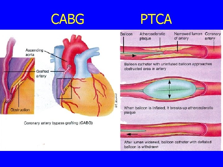 CABG PTCA 